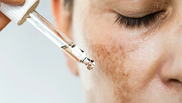 Hyperpigmentation in Dark Skin: What to Know