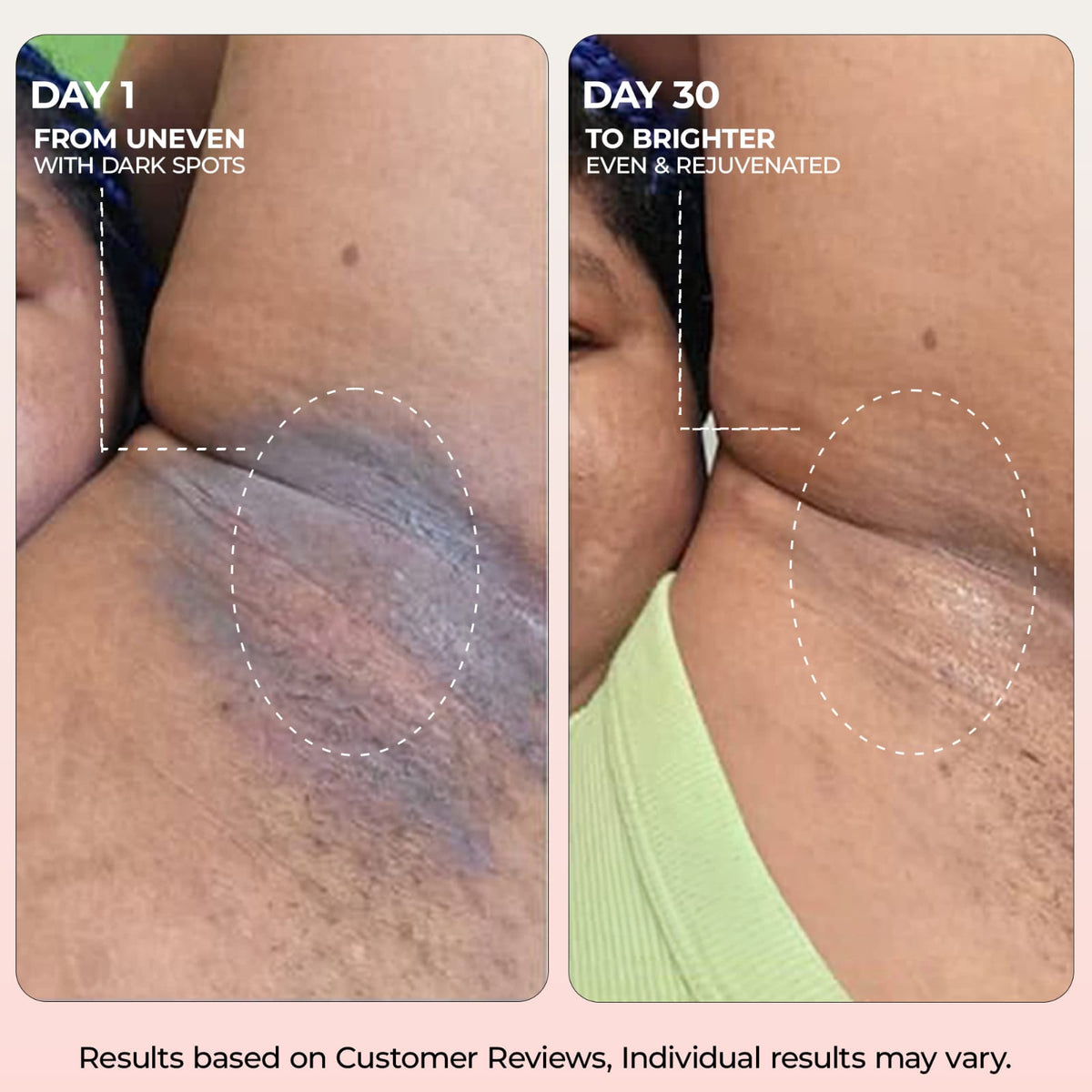 Tranexamic &amp; Niacinamide Advanced Brightening Cream for Hyperpigmentation