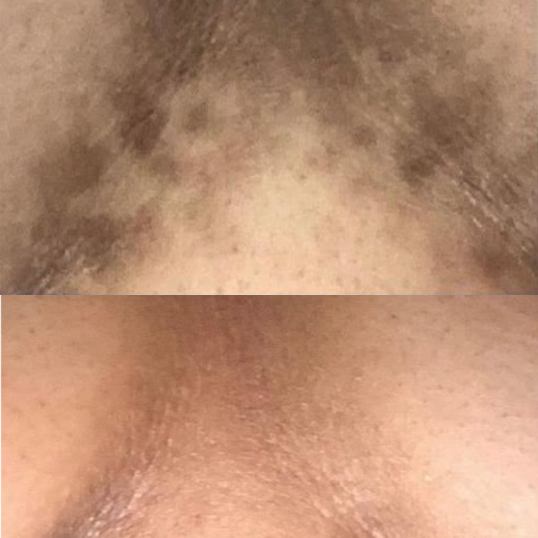 Before and after comparison of skin texture